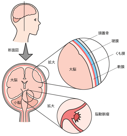 くも膜下出血