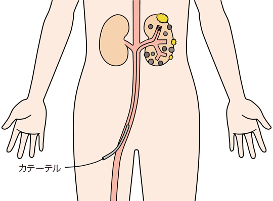 腎動脈塞栓療法