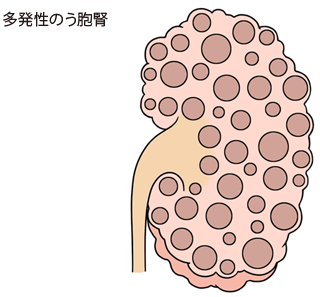 多発性嚢胞腎